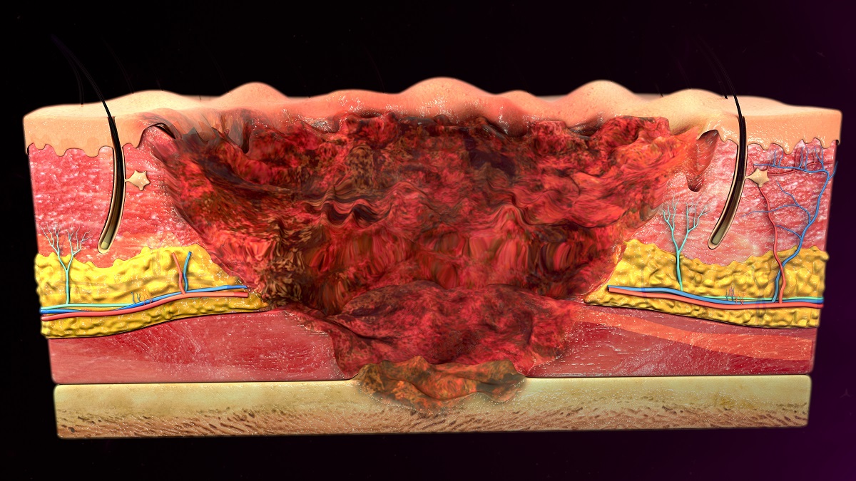 Uma queimadura de terceiro grau danifica todas as camadas da pele em toda a sua espessura. As queimaduras de quarto grau também danificam músculos, tendões ou ossos: Getty Images Uma queimadura de terceiro grau danifica todas as camadas da pele em toda a sua espessura. Uma queimadura de quarto grau também danifica músculos, tendões ou ossos.